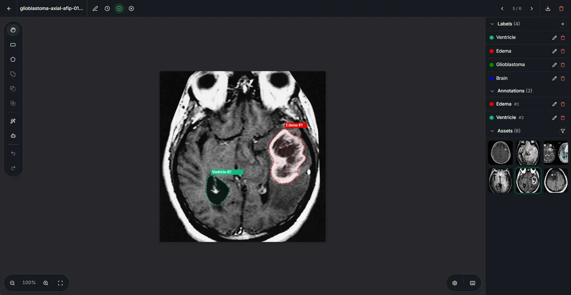 The Annota editor with segmentation annotations on a brain MRI slice