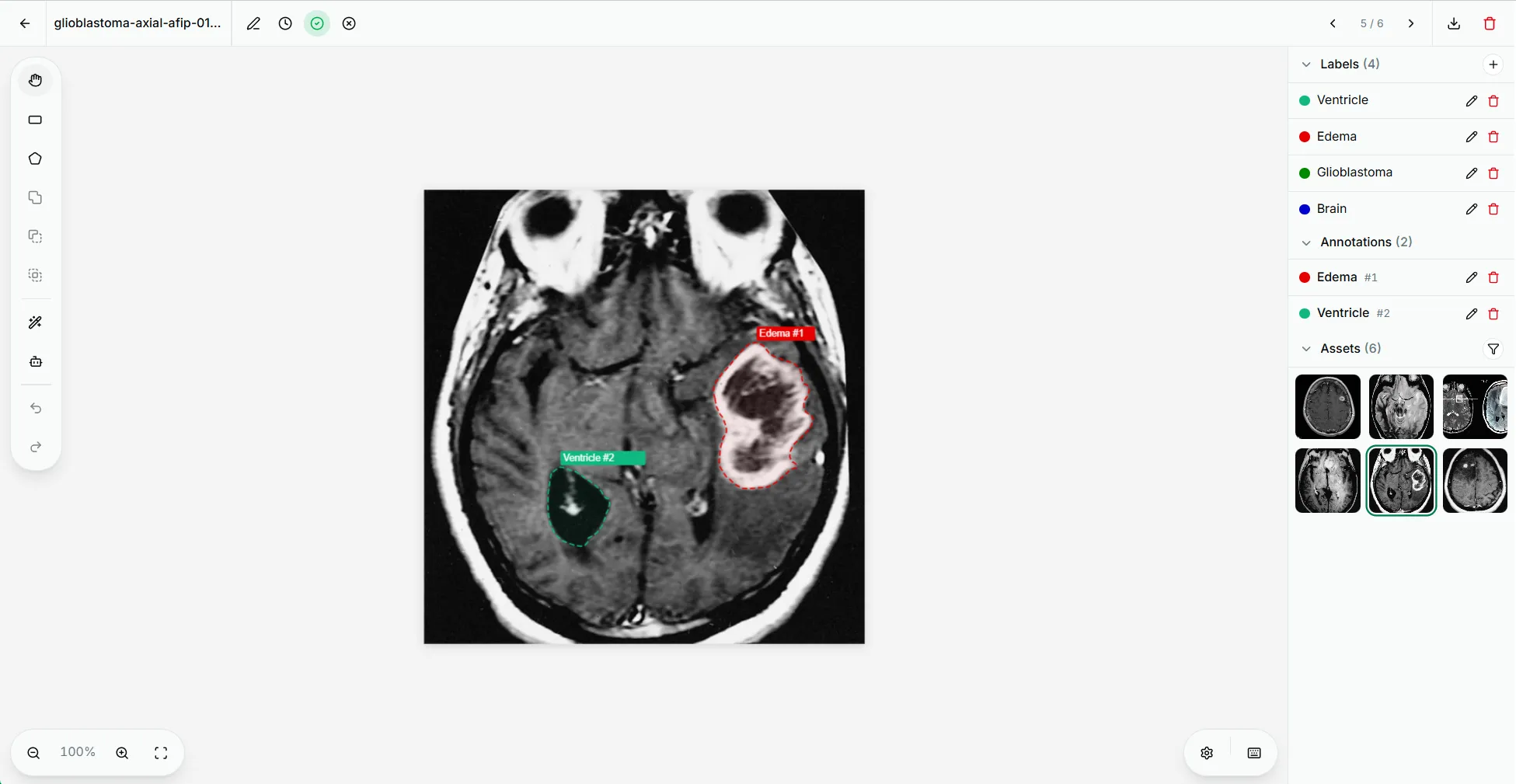 The Annota editor with segmentation annotations on a brain MRI slice